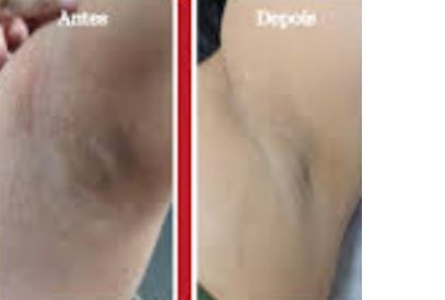 Resultado antes e depois 3